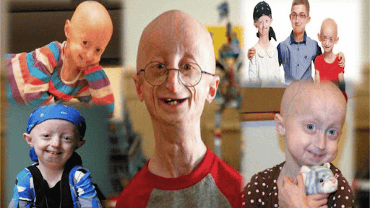 Progeria (Hutchinson-Gilford Progeria Syndrome): Current Affairs October 2025 | UPSC Daily GK Update | Atharva Examwise